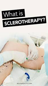 What is Sclerotherapy