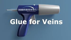 VenaSeal, superglue for varicose veins